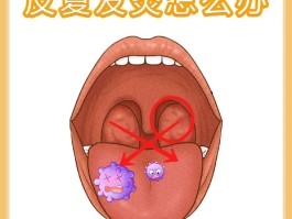 扁桃体发炎是什么原因(一感冒就扁桃体发炎是什么原因)